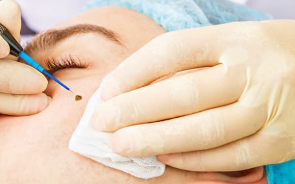 What Is Surgical Mole Removal?