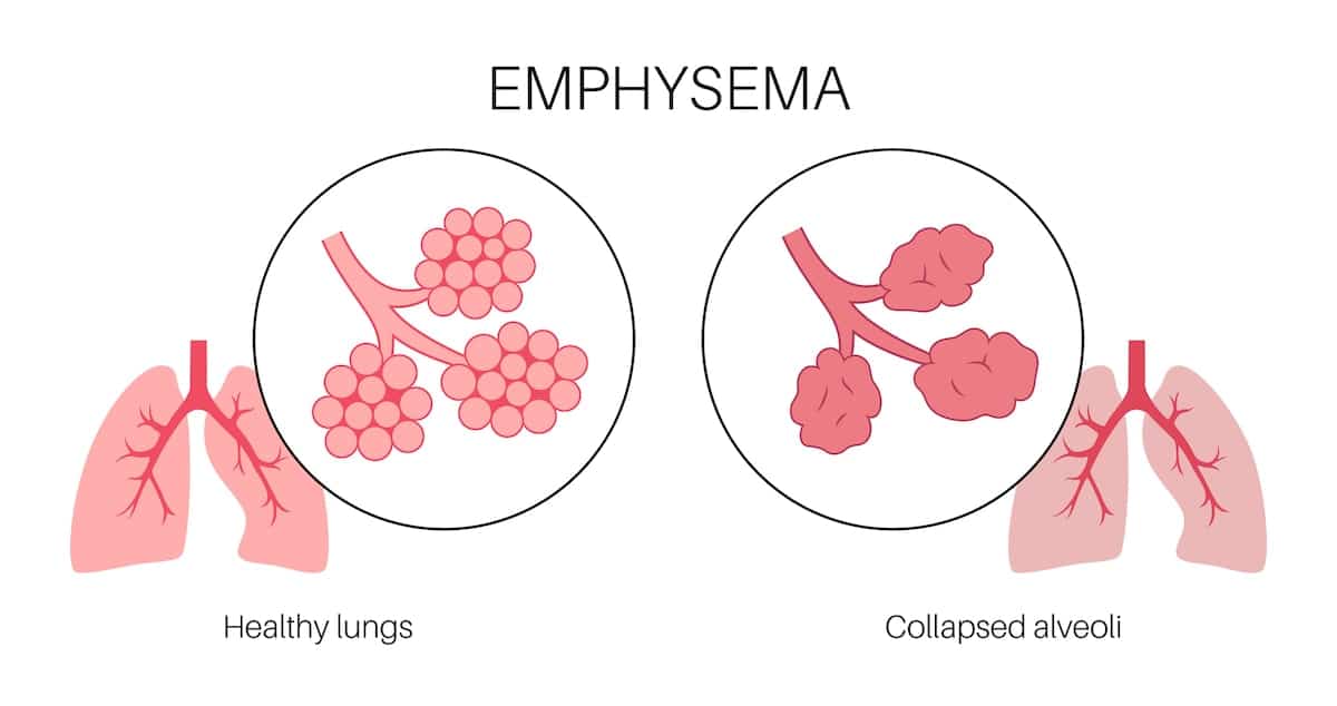 What is Emphysema?