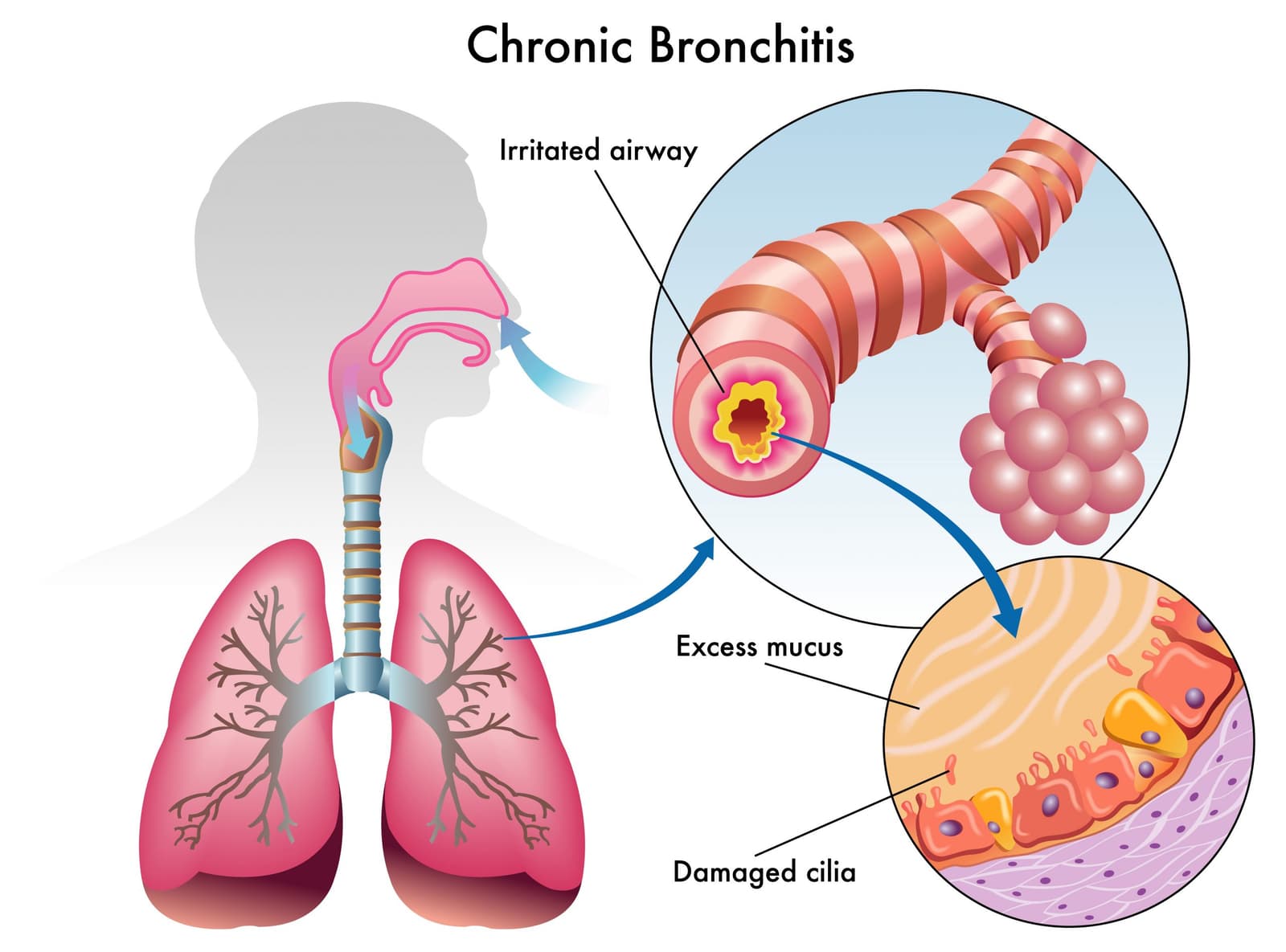 What is Chronic Bronchitis?