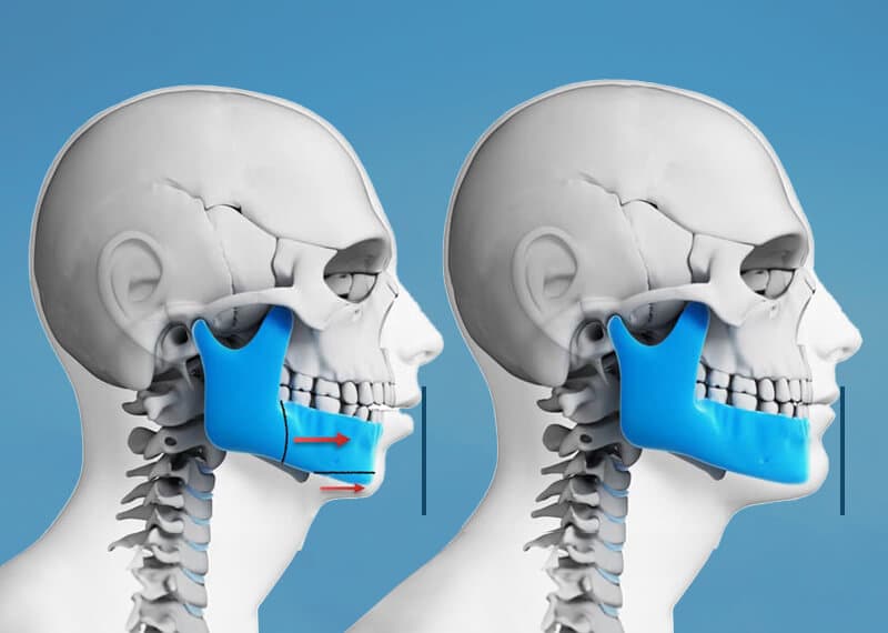 Jaw Relapse and Changes in Bite