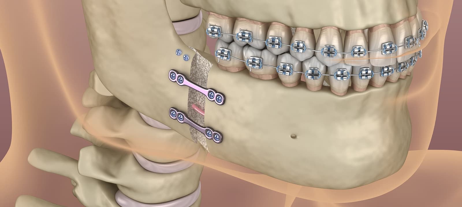 Does Jaw Surgery Cause Permanent Problems?