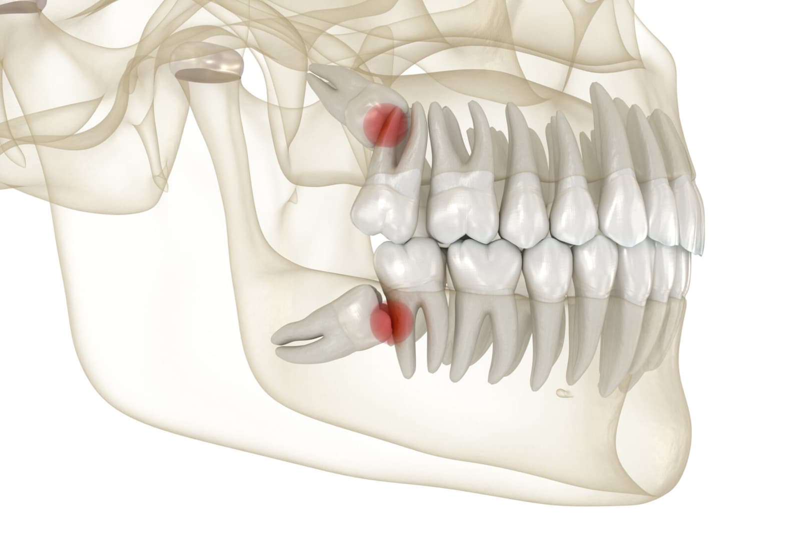 What If I Do Not Remove a Problematic Wisdom Tooth?