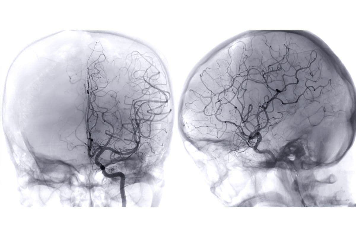 Cerebrovascular Surgery Potential Risks