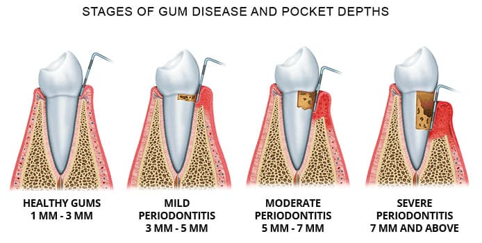 Can Gum Disease Develop Without Symptoms?