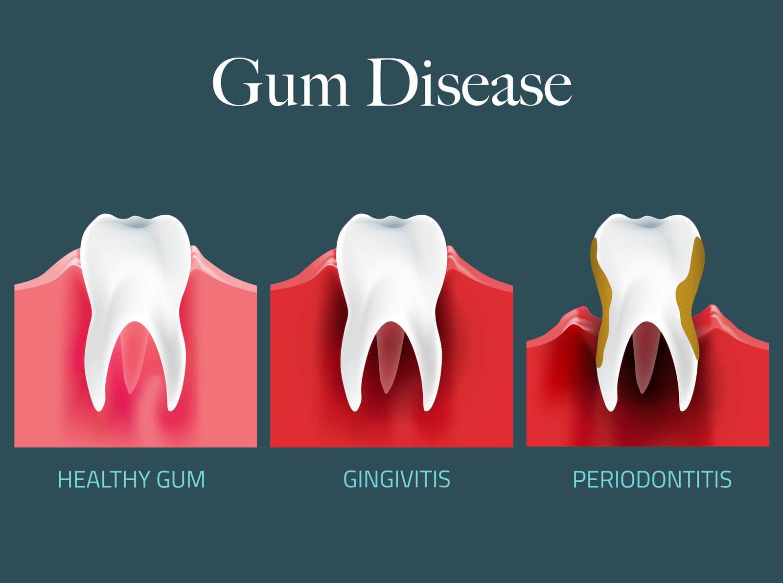 How Can You Prevent Gum Disease?