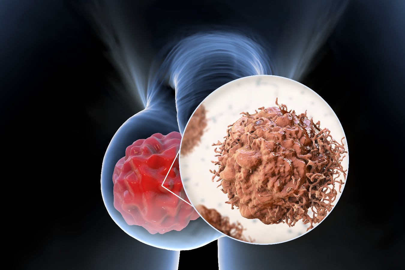 Surgery for Testicular Cancer