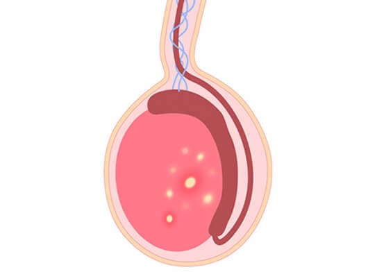 Recovery After Testicular Cancer Surgery