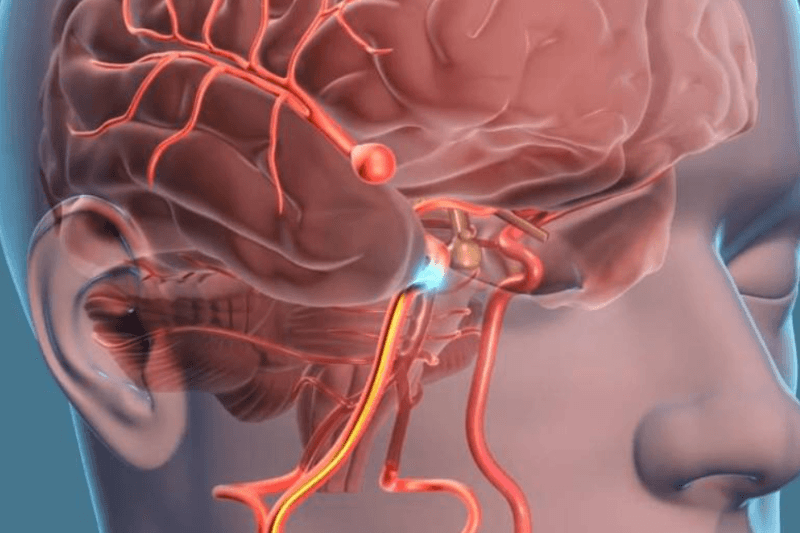 What Is Cerebrovascular Surgery?