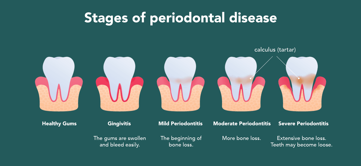 How Is Gum Disease Treated?