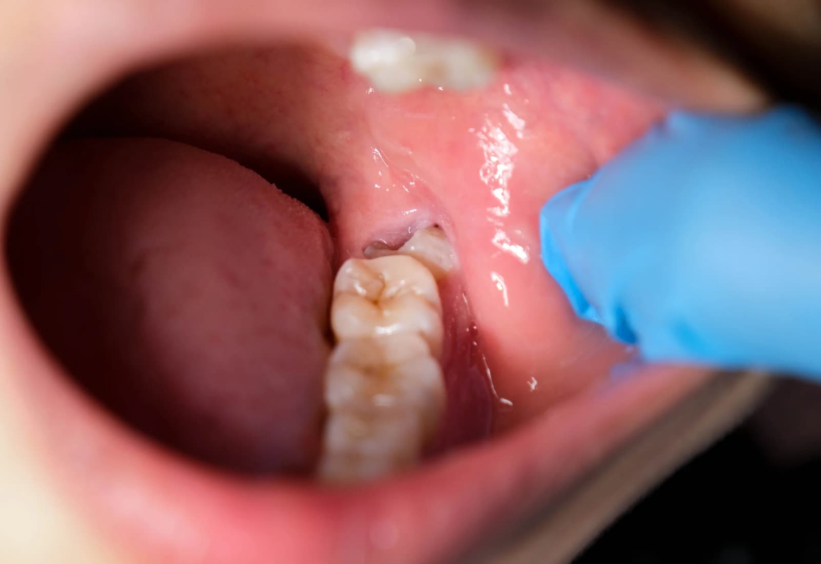 What Are Wisdom Teeth?