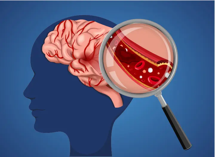 What is Cerebrovascular surgery used for?