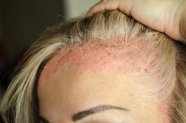 What are the signs & symptoms of Psoriasis?