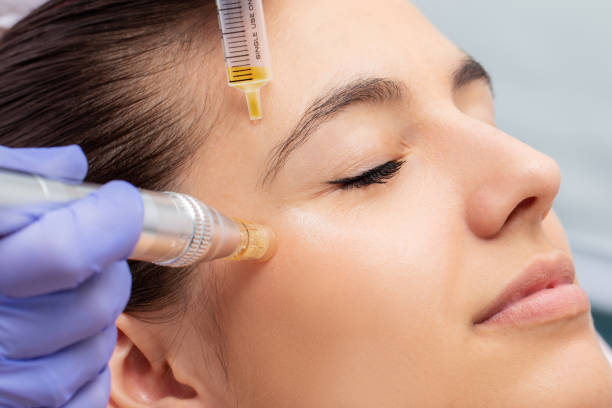 What are the pros & cons of microneedling?