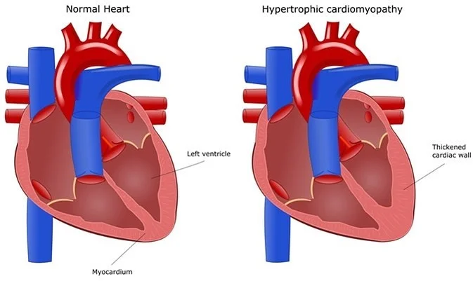 Congenital heart defect surgery risks