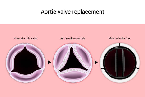 Why would I need a valve replacement?