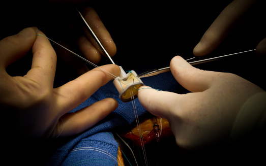 What are the types of Aortic valve surgery?