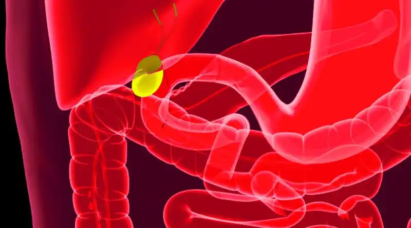 What is a cholecystectomy?